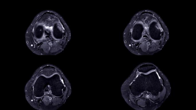 MRI膝关节或磁共振成像膝关节轴向stir视图。
