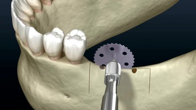 牙槽嵴的切割，增大，植入。牙科手术，3D动画。