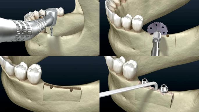 牙槽嵴的切割，增大，植入。牙科手术，3D动画。