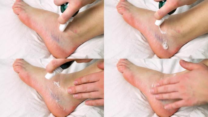 女人正在用弹性绷带在脚踝扭伤的腿上涂抹凝胶。扭伤脚踝，白色背景上有瘀伤