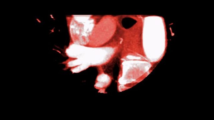 用MIP方法检测冠状动脉疾病的CTA冠状动脉短轴视图。