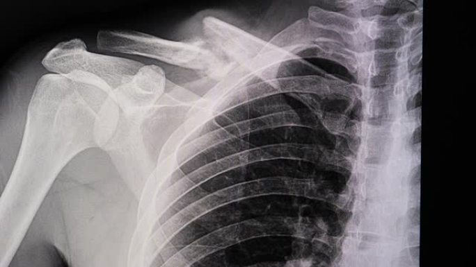 锁骨骨折的x光片。
