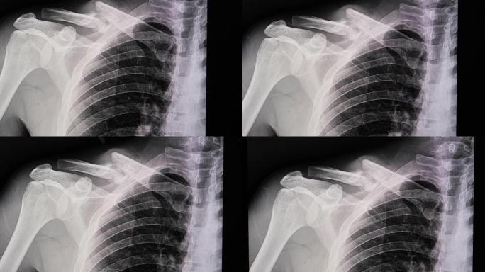 锁骨骨折的x光片。