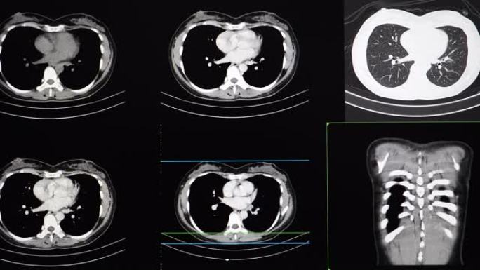 患者胸腔的ct扫描或计算机断层扫描