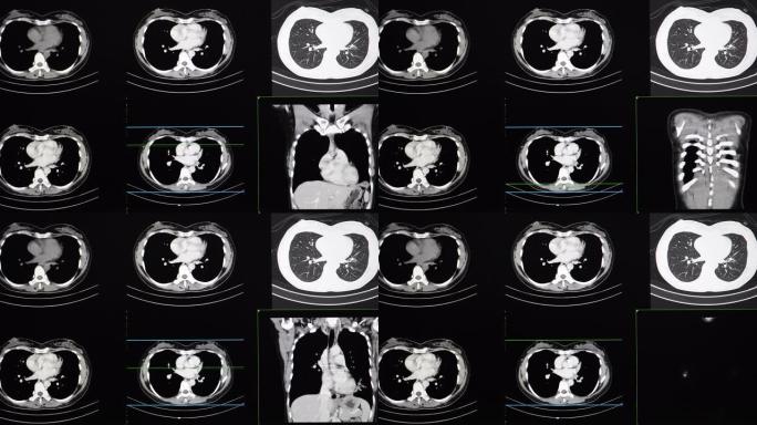 患者胸腔的ct扫描或计算机断层扫描