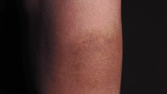 在黑色背景的特写镜头中，一个男人手臂上的淤青。瘀伤，电击，人类皮肤宏观，选择性聚焦