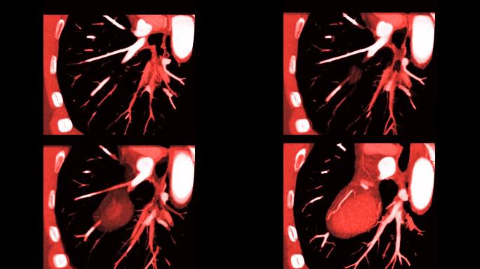 CTA冠状动脉垂直长轴视图，用MIP方法检测冠状动脉疾病。