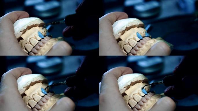 牙医医生在颌骨上做假牙。牙医手里拿着一个下颌植入物，用工具涂抹材料。牙科的现代技术。特写，全高清。