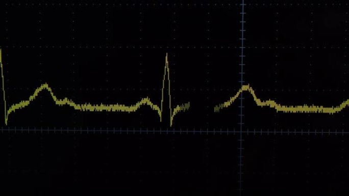 心电图波心电图波心电仪器心脏波动