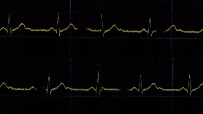心电图波心电图波心电仪器心脏波动