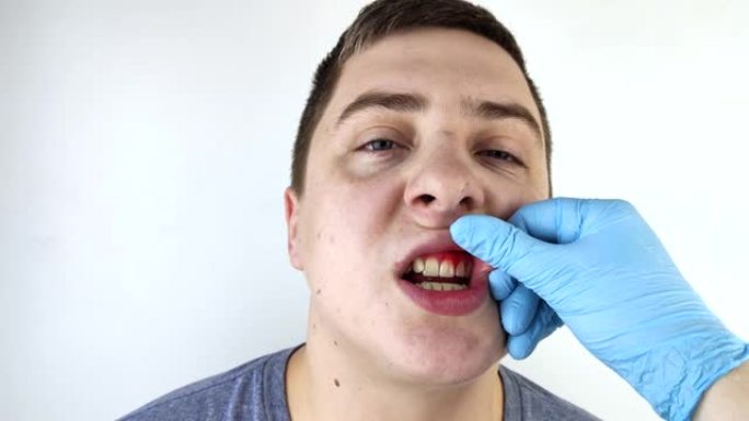 牙龈出血和炎症关闭。牙医检查的人。牙龈炎的诊断