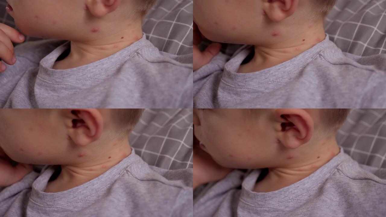 一个小男孩脖子上有水痘水泡的特写镜头。