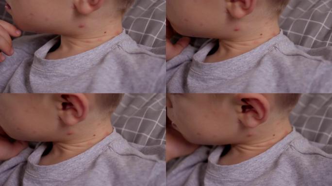 一个小男孩脖子上有水痘水泡的特写镜头。