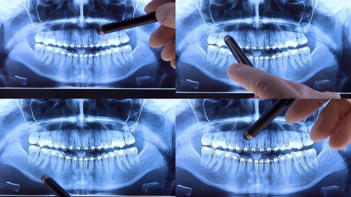 口腔科医生用牙套分析牙科射线照相