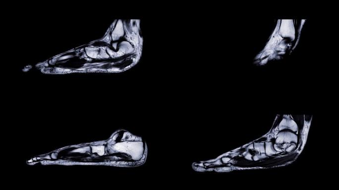 MRI足矢状位T2W。