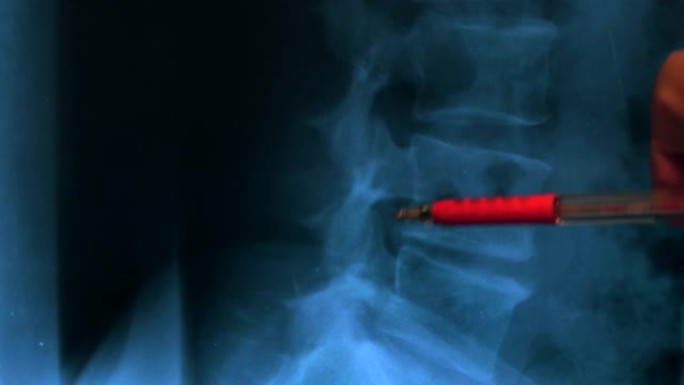 人体脊柱骨骼的x射线