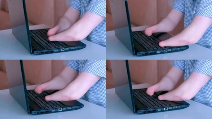 一个双手被截肢的残疾人在笔记本电脑上打字，特写镜头。