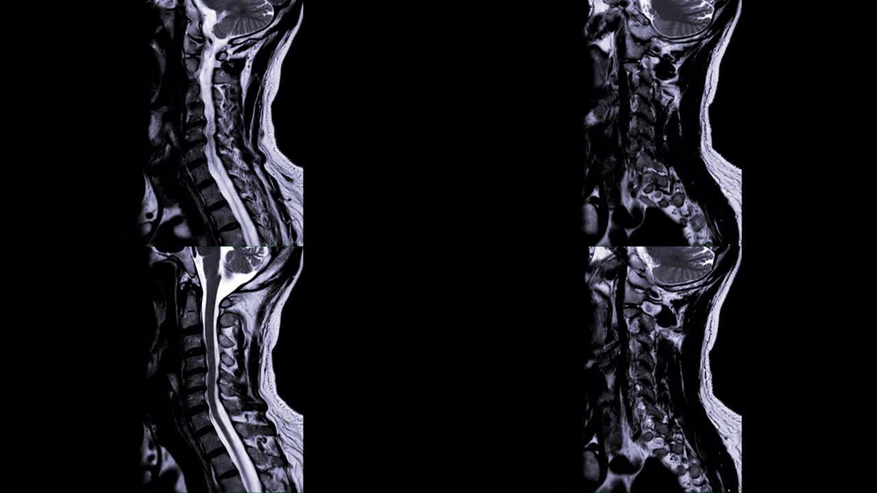 MRI颈椎矢状位T2W视图，用于诊断C3，c4的脊髓压迫。