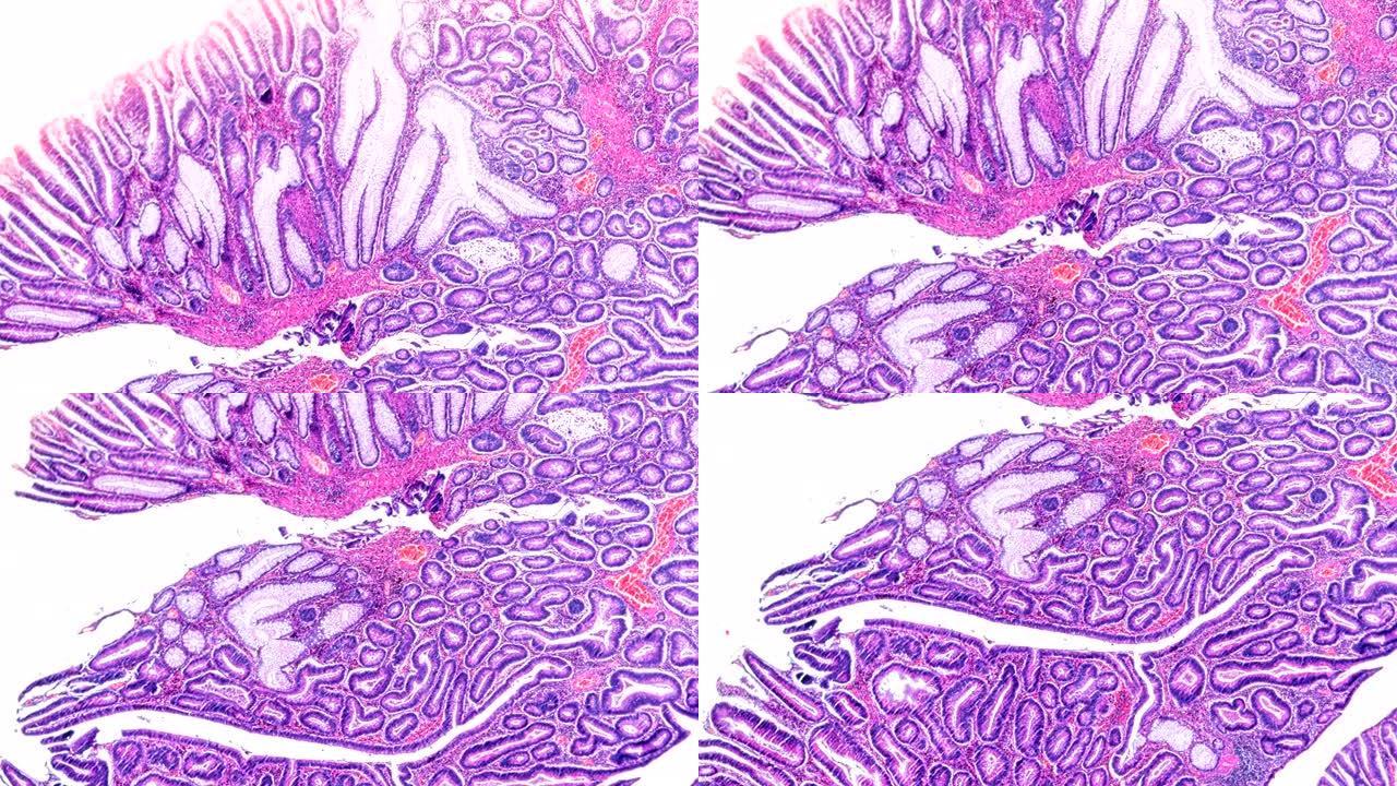 显微镜下不同区域的大肠癌 (不同管状腺癌)