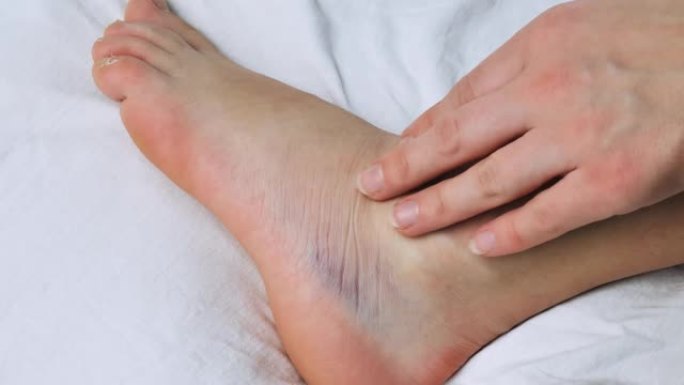 女人正在用弹性绷带在脚踝扭伤的腿上涂抹凝胶。扭伤脚踝，白色背景上有瘀伤