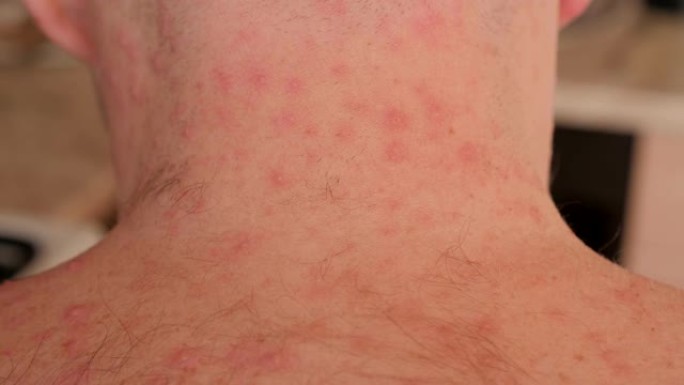 长有水痘丘疹的成年男性的毛茸茸的背部和颈部。