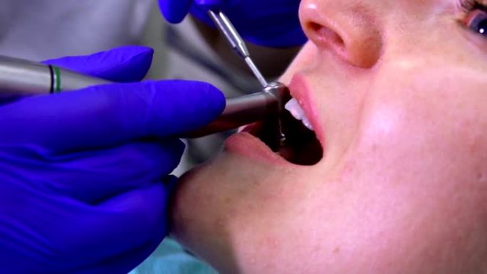 张开嘴进行专业牙齿清洁的牙医的特写
