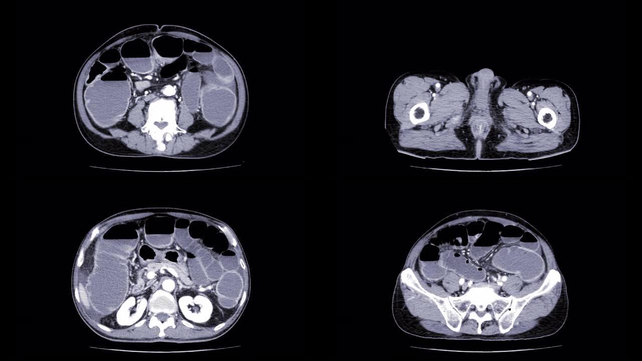 CT全腹部对比剂轴位显示肠梗阻。