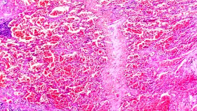 不同区域显微镜下的间质性肺炎人类病理样本