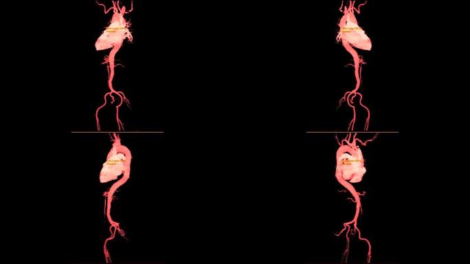 CTA全主动脉3D MIP图像在屏幕上翻转以检测主动脉瘤。