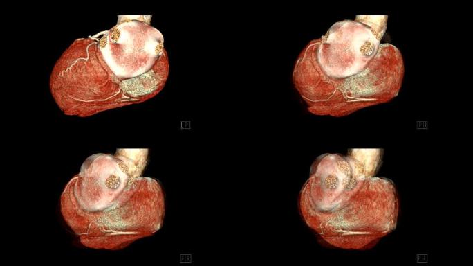 CTA冠状动脉3D渲染图像在屏幕上翻转以诊断血管冠状动脉狭窄。