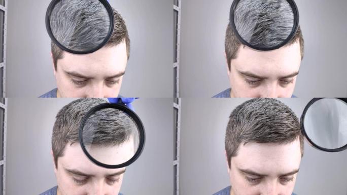 一位毛发学家在放大镜下检查了一个年轻人的白发。头发和色素的早期漂白是男人体内黑色素含量低的标志
