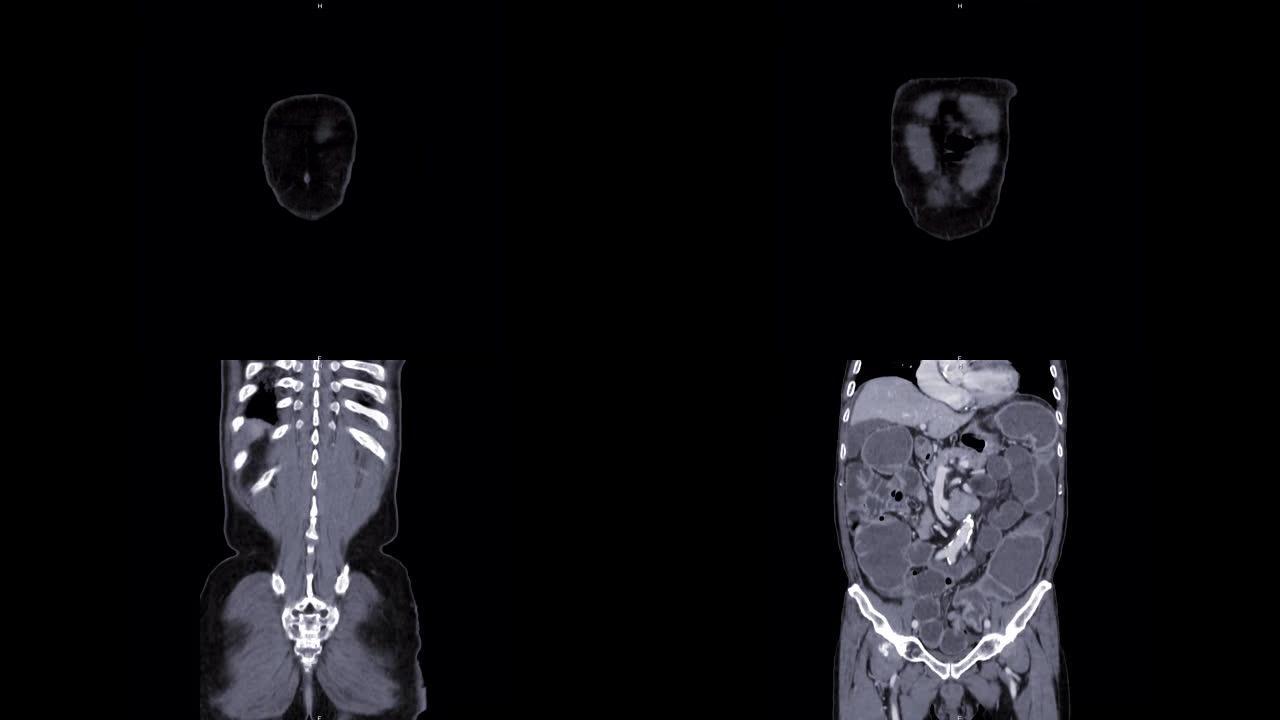CT全腹部对比剂冠状视图显示肠梗阻。