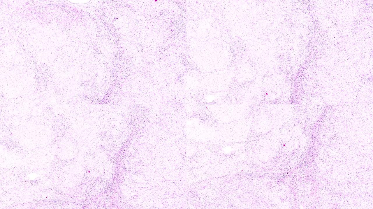 显微镜下局灶性结节性肝硬化人体病理样本