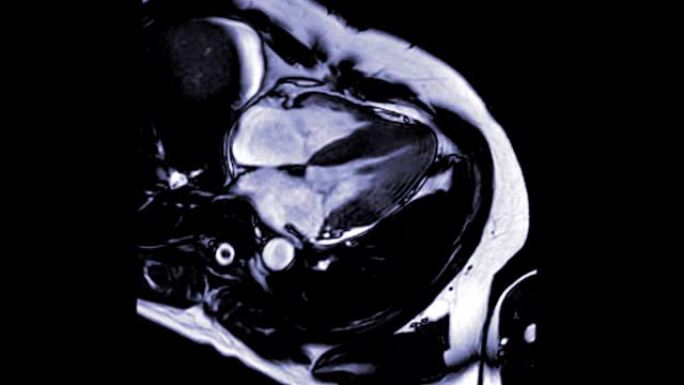 MRI心脏或心脏MRI 4室视图