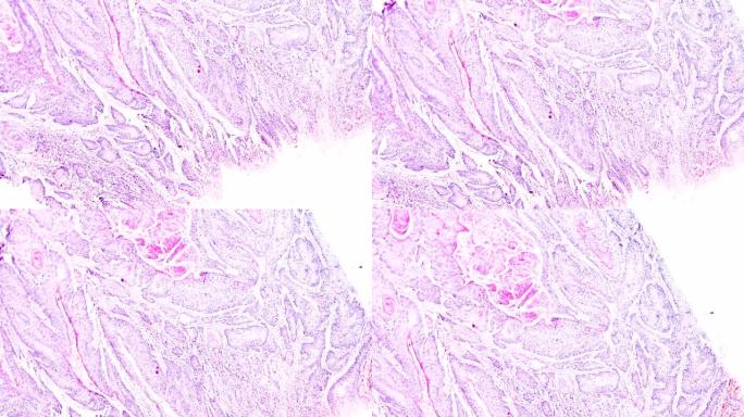 子宫颈癌 (鳞状细胞癌) 光学显微镜下放大不同区域