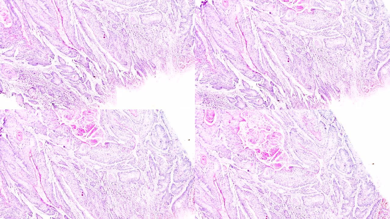 子宫颈癌 (鳞状细胞癌) 光学显微镜下放大不同区域