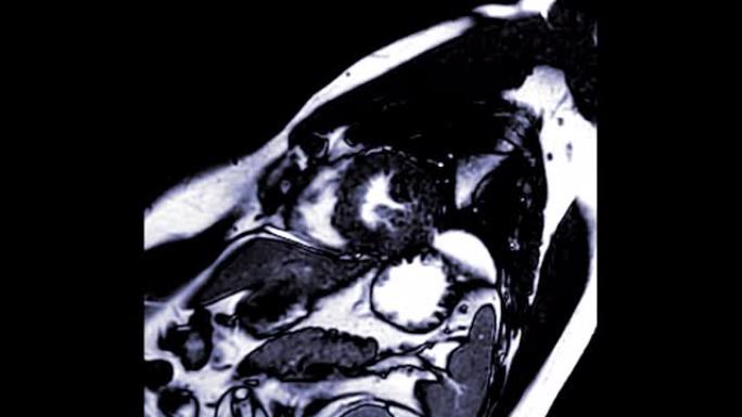 MRI心脏或心脏MRI短轴视图。