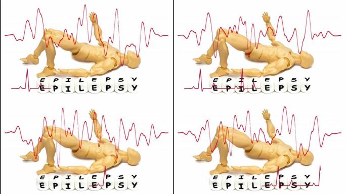 癫痫发作姿势的模型，字母拼写为癫痫