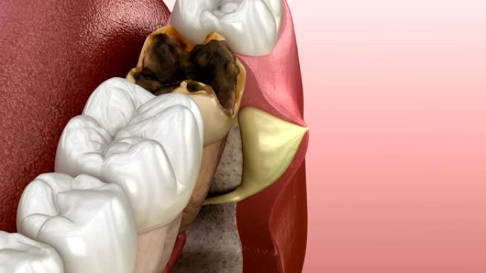 骨膜炎牙齿-牙齿上方牙龈上的肿块。医学上精确的牙科3D动画