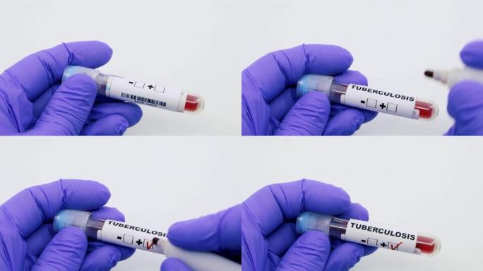 微生物学家或医务工作者用蓝色手术手套将血液检查结果标记为结核病阳性的特写镜头。结核病阳性概念