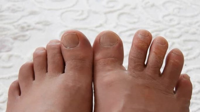 脚趾上的一种真菌病，脚部皮肤病，