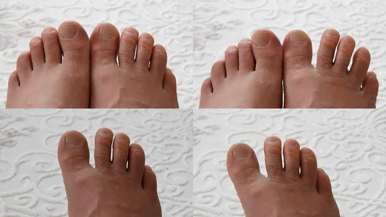 脚趾上的一种真菌病，脚部皮肤病，