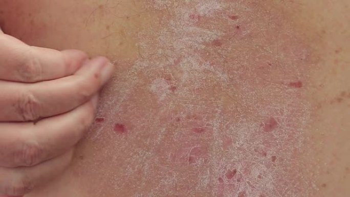 牛皮癣: 一个人用手在他的背上刮牛皮癣皮疹