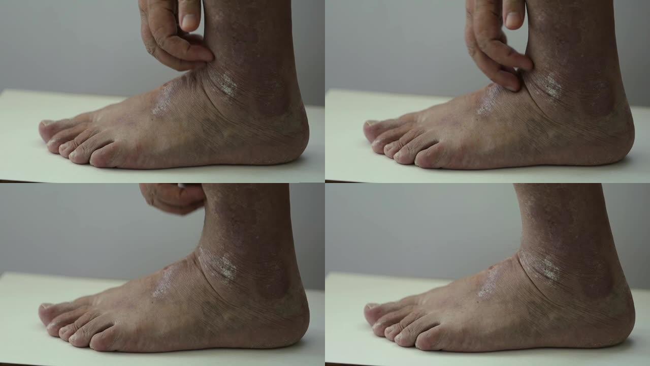牛皮癣。一名男子梳理受银屑病斑块影响的足部区域