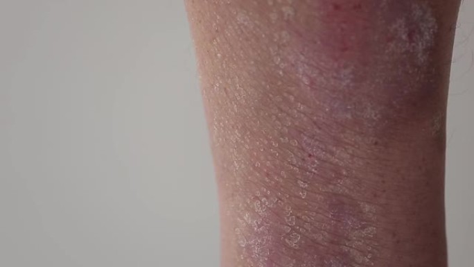 牛皮癣。一名男子梳理受银屑病斑块，皮疹和伤口影响的小腿区域。特写。