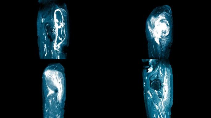 髋关节矢状面磁共振成像 (MRI)。在右臀大肌和臀中肌的肌内区域找到一个大型的混合异质液体集合。