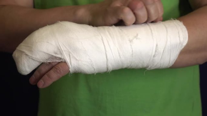 一个男人在石膏中抓伤了他的手臂。
