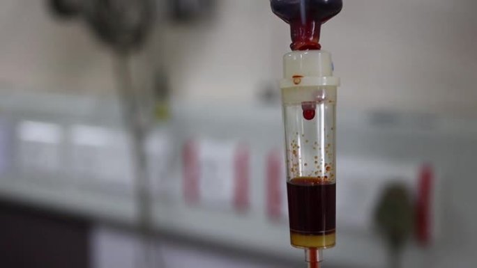 在输血和输铁时，在输液器中滴血的特写镜头。