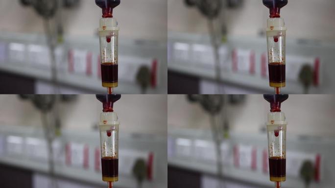 在输血和输铁时，在输液器中滴血的特写镜头。