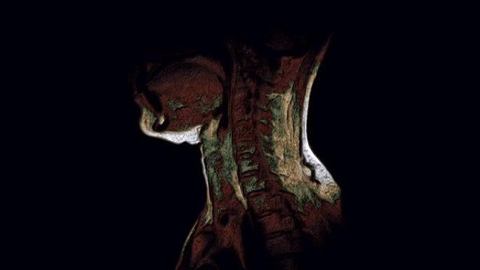 颈椎的整体彩色MRI，突起和疝气的检测